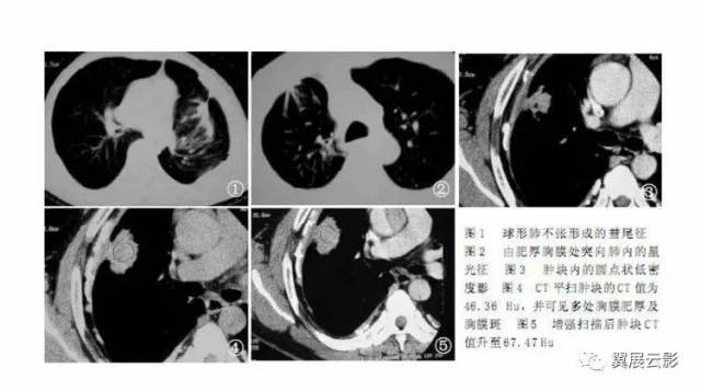全球肺炎動態(tài)更新，共同應(yīng)對挑戰(zhàn)與未來展望